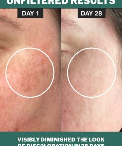 chlorophyll discoloration serum
